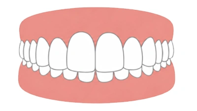 Surocclusion dentaire /  supraclusion dentaire
